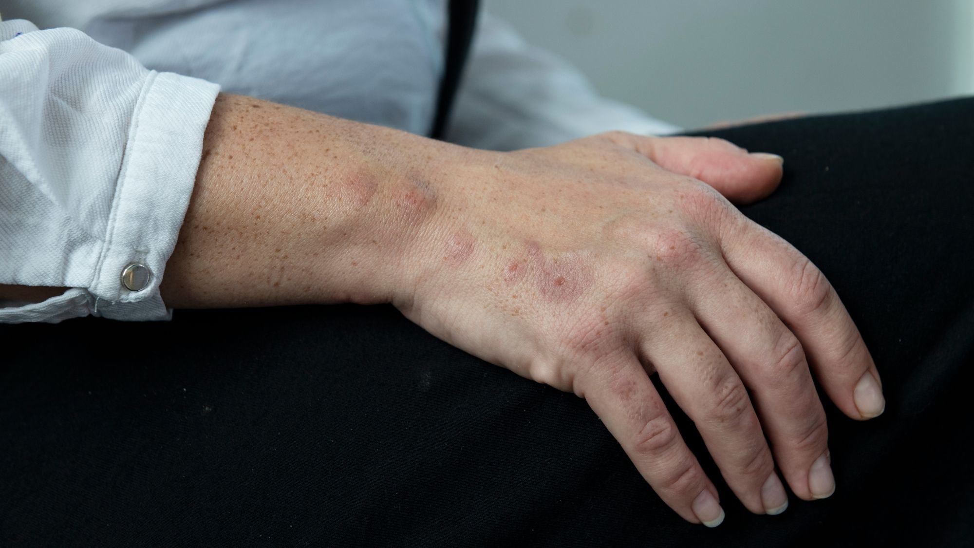 Bed bug bites are usually in a cluster or a line